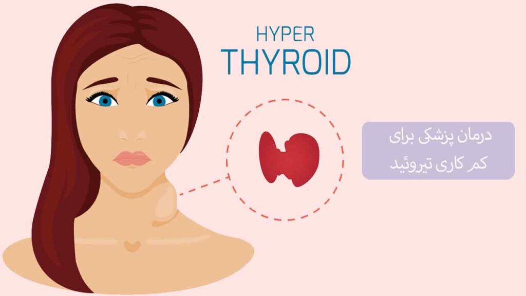 درمان پزشکی برای کم کاری تیروئید