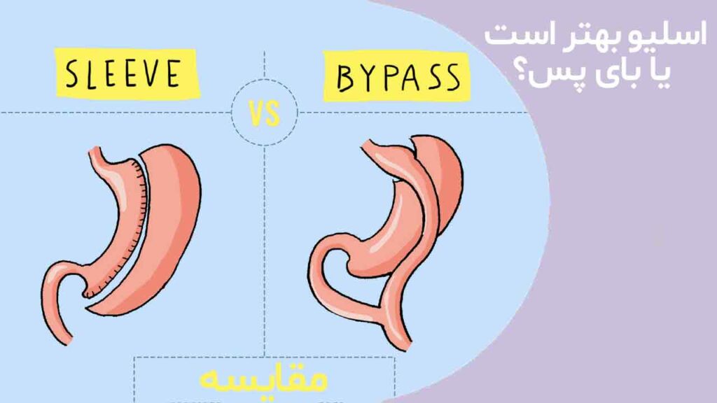 اسلیو بهتر است یا بای پس