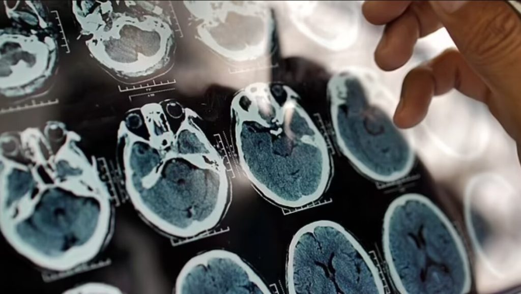 پیشبینی رشد قابل توجه آمار آلزایمر در ایران و اهمیت تشخیص زود هنگام