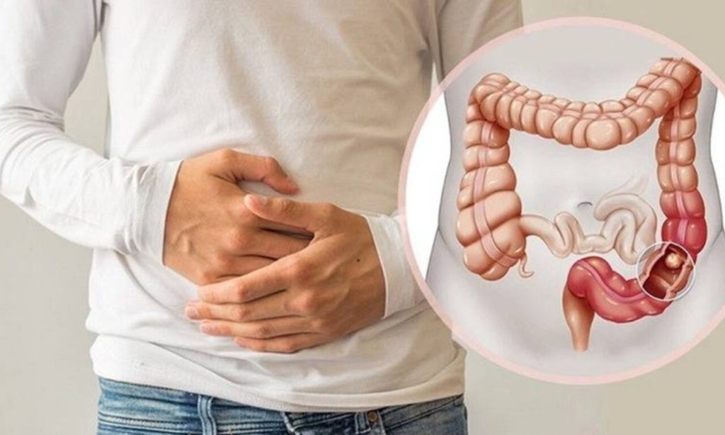 علل مقاومتر بودن برخی انواع یبوست و نقش میکروبیها، سیستم ایمنی و اعصاب در درمان